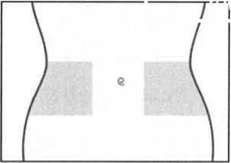 Эноксапарин натрия-АМЕДАРТ